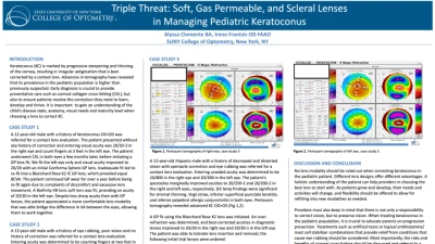 TRIPLE THREAT: Soft, Gas Permeable, and Scleral Lenses in Managing Pediatric Keratoconus