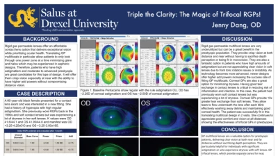 12A: Triple the Clarity: The Magic of Trifocal Rgps!