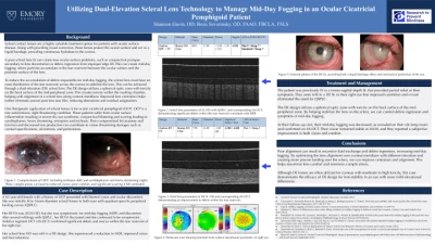 Utilizing Dual-Elevation Scleral Lens Technology to Manage Mid-Day Fogging in an Ocular Cicatricial Pemphigoid Patient