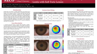 Out of Place, Not Out of Sight: Managing Ectopia Lentis with Soft Toric Lenses