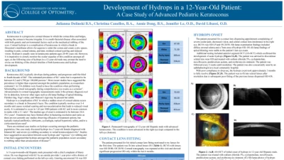 03A: Development of Hydrops In a 12-Year Old Patient: A Case Study of Advanced Pediatric Keratoconus