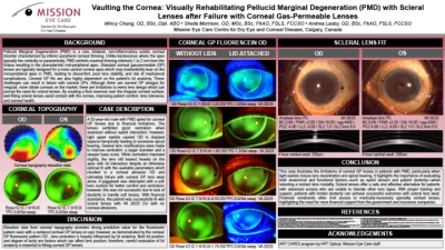 Vaulting the Cornea: Visually Rehabilitating Pellucid Marginal Degeneration (PMD) with Scleral Lenses after Failure with Corneal Gas-Permeable Lenses