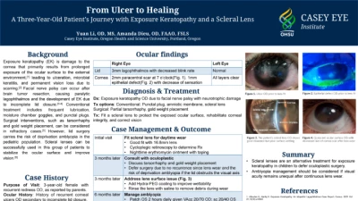 66A: From Ulcer to Healing- A Three-Year-Old Patient’s Journey with Exposure Keratopathy and a Scleral Lens
