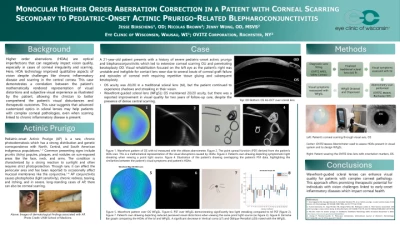 Monocular Higher Order Aberration Correction in a Patient with Corneal Scarring Secondary to Pediatric-Onset Actinic Prurigo-Related Blepharoconjunctivitis