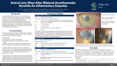 64A: Scleral Lens Wear After Bilateral Acanthamoeba Keratitis – An Inflammatory Sequelae