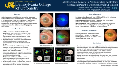 Selective Suture Removal in Post-Penetrating Keratoplasty Keratoconus Patient to Optimize Corneal GP Lens Fit