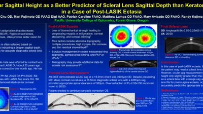 Ocular Sagittal Height as a Better Predictor of Scleral Lens Sagittal Depth than Keratometry in a Case of Post-LASIK Ectasia