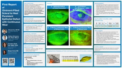 First Report of Ointment-Filled Scleral Lens to Heal Persistent Epithelial Defect with Continuous Wear