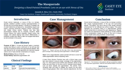 68A: The Masquerade: Designing a Scleral Hand-Painted Lens on a Nevus of Ota