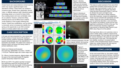 Precision Vision: HOA Corrected Dual Sagittal Scleral Lens in Traumatic Aphakia