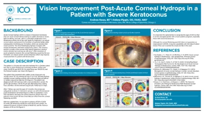 Vision Improvement Post-Acute Corneal Hydrops in a Severe Keratoconus Patient