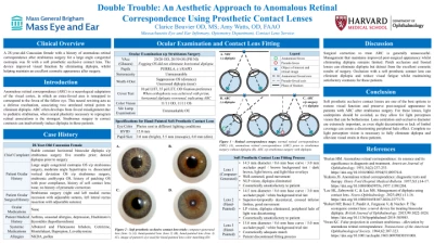 Double Trouble: An Aesthetic Approach to Anomalous Retinal Correspondence Using Prosthetic Contact Lenses