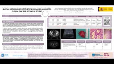 Gluteal Metastasis of Intrahepatic Cholangiocarcinoma. Clinical Case and Literature Review