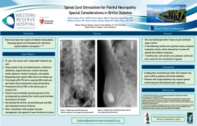 Spinal Cord Stimulation for Painful Neuropathy: Special Considerations in Brittle Diabetes