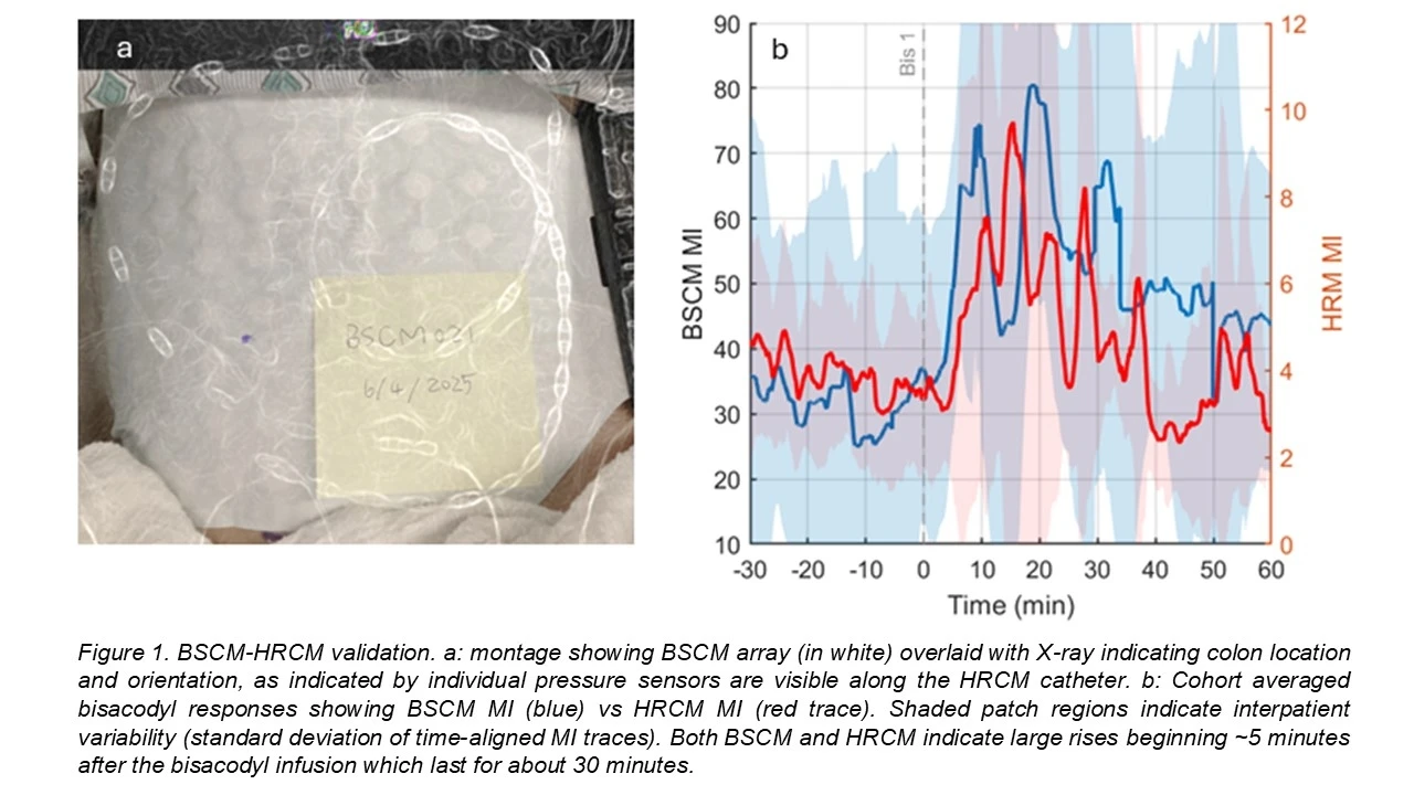 High Resolution Manometry Colon BODY SURFACE COLONIC MAPPING CORRELATES WITH HIGH RESOLUTION COLONIC ...