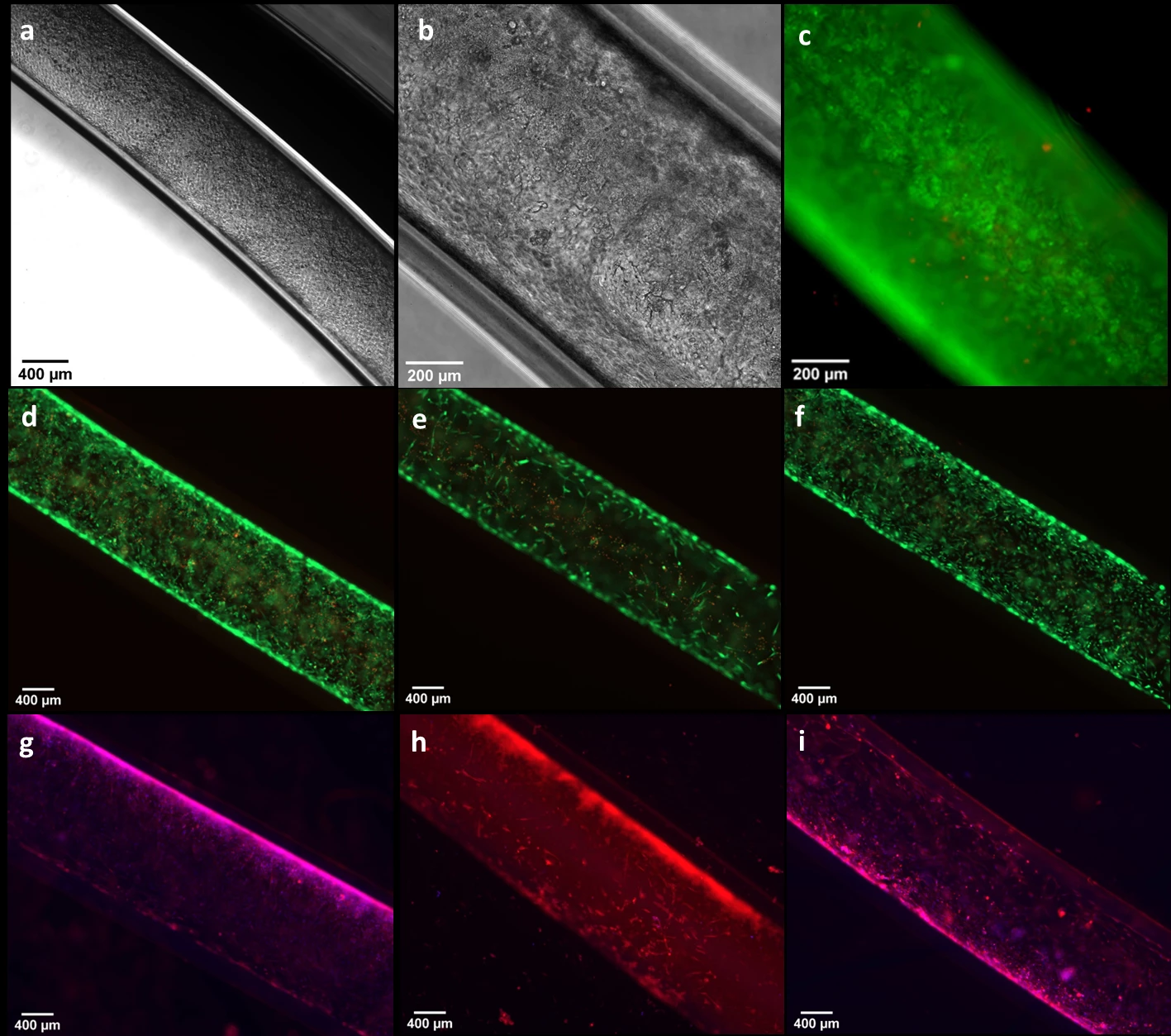 Figure 1: a, b) brightfield microscopic images of co-cultured InMyoFibs+CaCO2 cells in the lumen of bioprinted tubes at day 4 after seeding CaCO2 cells; c) viability of co-cultured InMyoFibs+CaCO2 cells in the lumen of bioprinted tubes at Day 10 after seeding CaCO2 cells; d, e, f) microscopic images showing the viability of InMyoFibs+InEpCs +CaCO2 cells in the lumen bioprinted tubes at day 7 after addition of 1.5 ug/ml bleomycin, 10 mg/ml for minocycline and 40 ng/ml TGF-beta1, respectively (note that the green color represents live cells, and the red represents dead cells); g, h, i) microscopic images showing immunostained for Collagen-I at Day 7 of 1.5 ug/ml bleomycin, 10 mg/ml for minocycline and 40 ng/ml TGF-beta1, respectively.