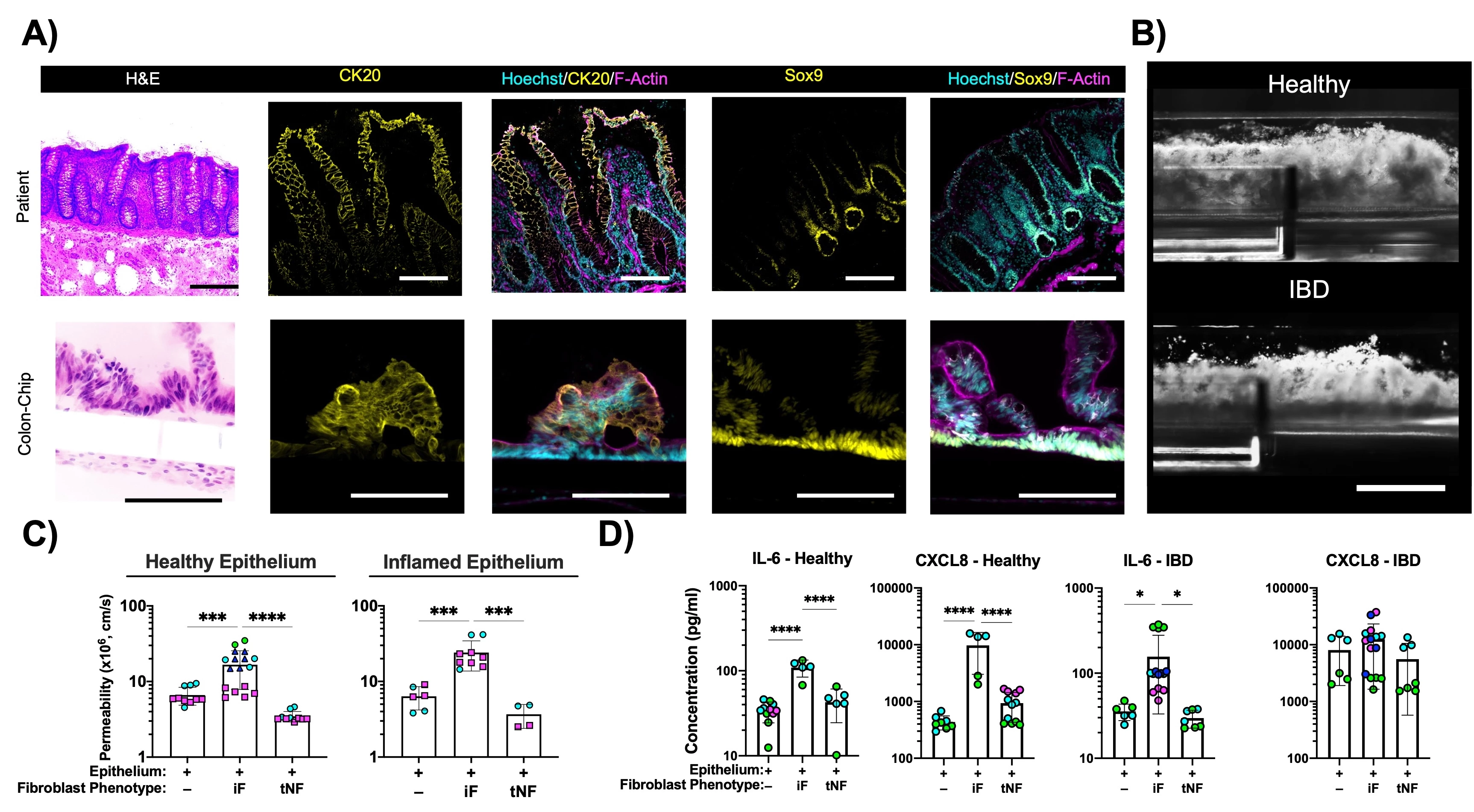 Primary human Colon Chips generated with epithelium and fibroblasts isolated from healthy and IBD patient samples. A) Representative H&E and immunofluorescent stained images of colon epithelium-specific markers expressed in patients and matching colon-chip. Scales are 200 μm. B) Representative images of mucus layer height visualization using dark-field microscopy of healthy and IBD colon-chips. Mucus production decreased in IBD colon-chips. Scales are 1 mm C) Fibroblast phenotype can regulate permeability to 0.59 kDa cascade blue in healthy and IBD epithelium. Inflammatory fibroblasts (iF) can increase healthy epithelium leakiness where true normal fibroblast (tNF) can normalize IBD epithelium leakiness. D) Inflammatory cytokine secretion in healthy and IBD epithelium under the influence of healthy and IBD fibroblasts. Fibroblasts phenotype can regulate inflammation in colon-chips. Each color represents a patient. n = 3 healthy and IBD patients * p<0.05, *** p<0.005, ****p<0.001.