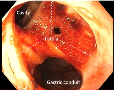 Figure 1. Demonstration of Communication Through Esophago-Gastric Anastomosis to the Post Pneumonectomy Cavity/ Dead Space