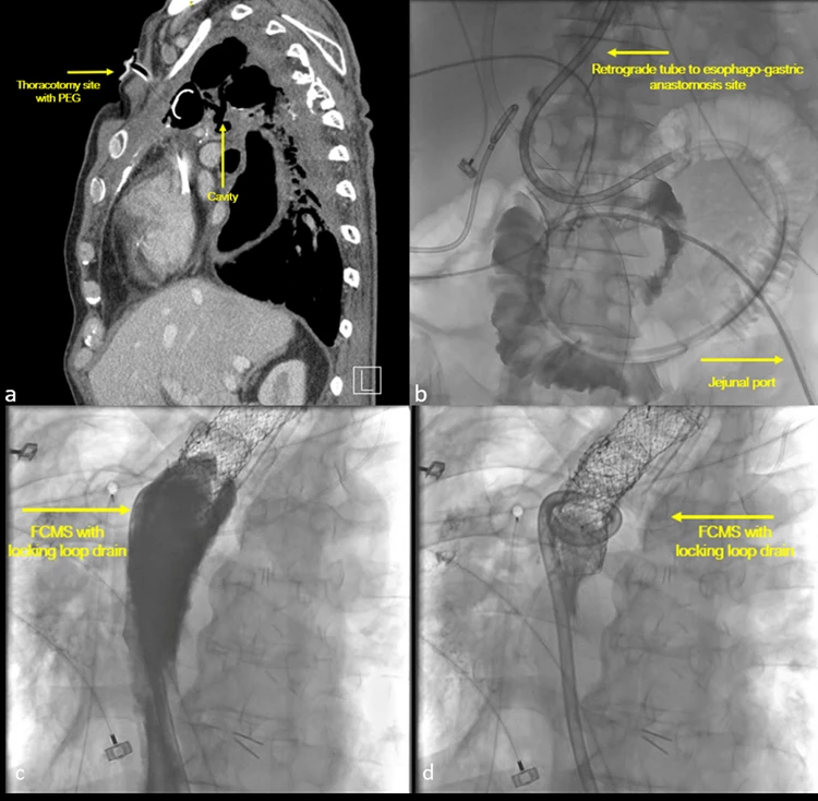 Figure 2. (a) Thoracotomy with PEG tube to drain cavity. (b) Retrograde double lumen percutaneous endoscopic jejunogastric tube inserted retrograde into esophagogastric anastomotic site. (c,d) Contrast injected into fully covered metal stent with locking loop drain to suction out any orally consumed material with suction off (c), and suction on (d).