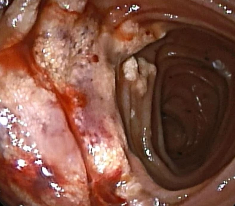 FIGURE 1. Large hemorrhagic lymphangioma in proximal ileum on double balloon enteroscopy.