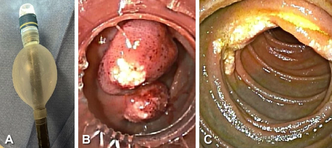 FIGURE 2A. Bander compatibility with the FUJI double balloon enteroscope. 2B. Band ligation of the lymphangioma. 2C. Follow up exam with eradication of the hemorrhagic lesion.
