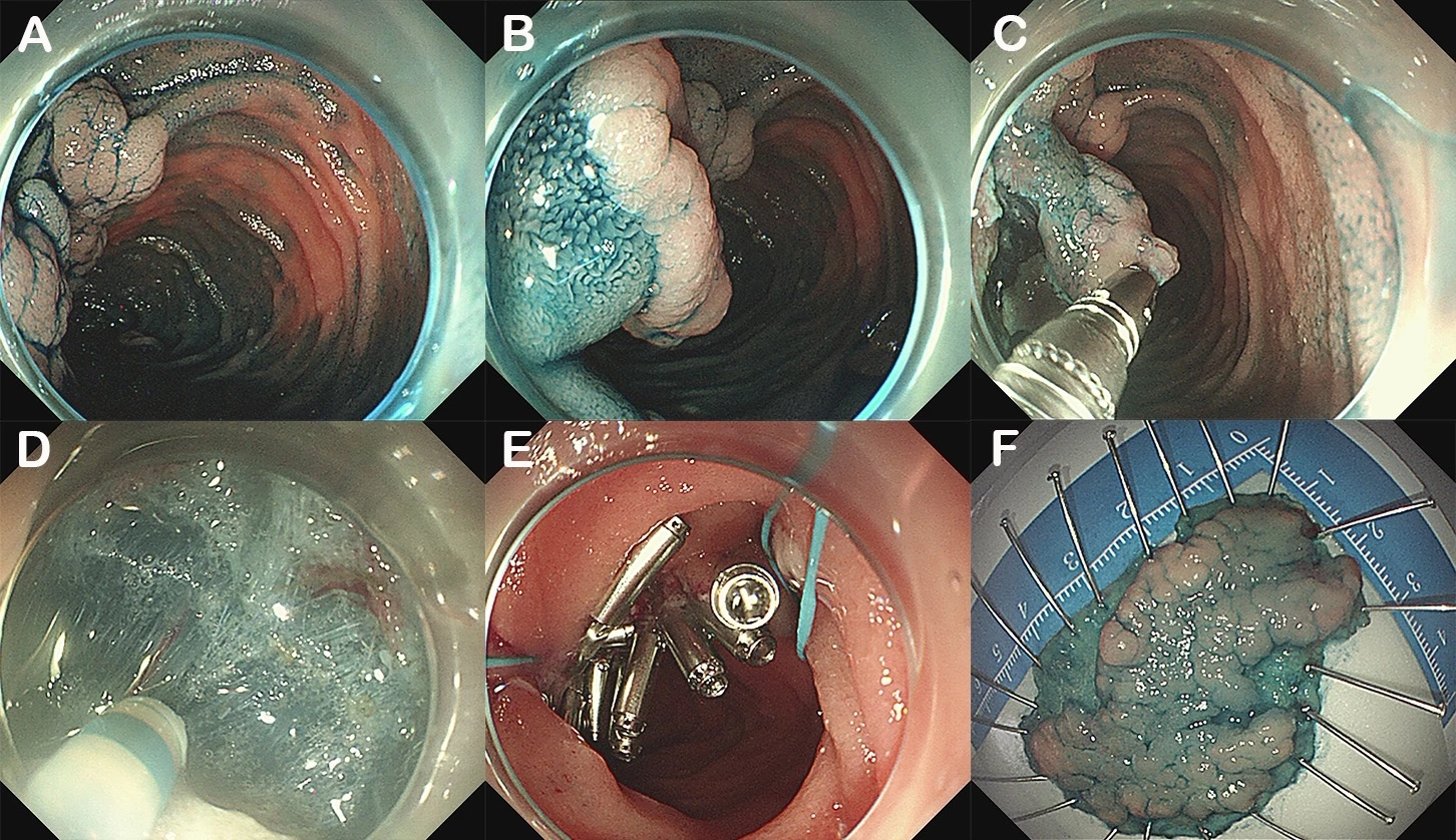 <b>Figure 2. </b>A laterally spreading tumor (LST) located on the major papilla resected by the modified ESD technique. (A) A 45mm×25mm LST located on the papilla. (B) A mucosal incision is made over the semicircle. (C) Internal traction made using an endoclip. (D) Submucosal dissection was performed until the lesion was resected completely. (E) Wound partially closed with endoloop and clips. (F) The resected specimen.