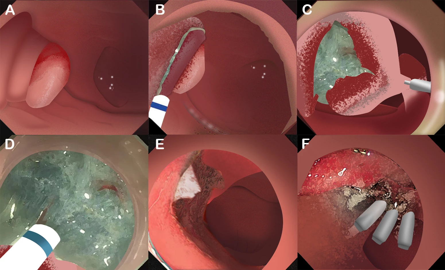 <b>Figure 1. </b>An iillustration of the modified ESD technique for the treatment of superficial PAs. (A) A major papillary adenoma. (B) Submucosal injection and a semi-circular mucosal incision. (C) Traction assisted endoscopic submucosal dissection. (D) Submucosal layer was dissected until the lesion was completely resected. (E) The wound. (F) The wound was partially closed.