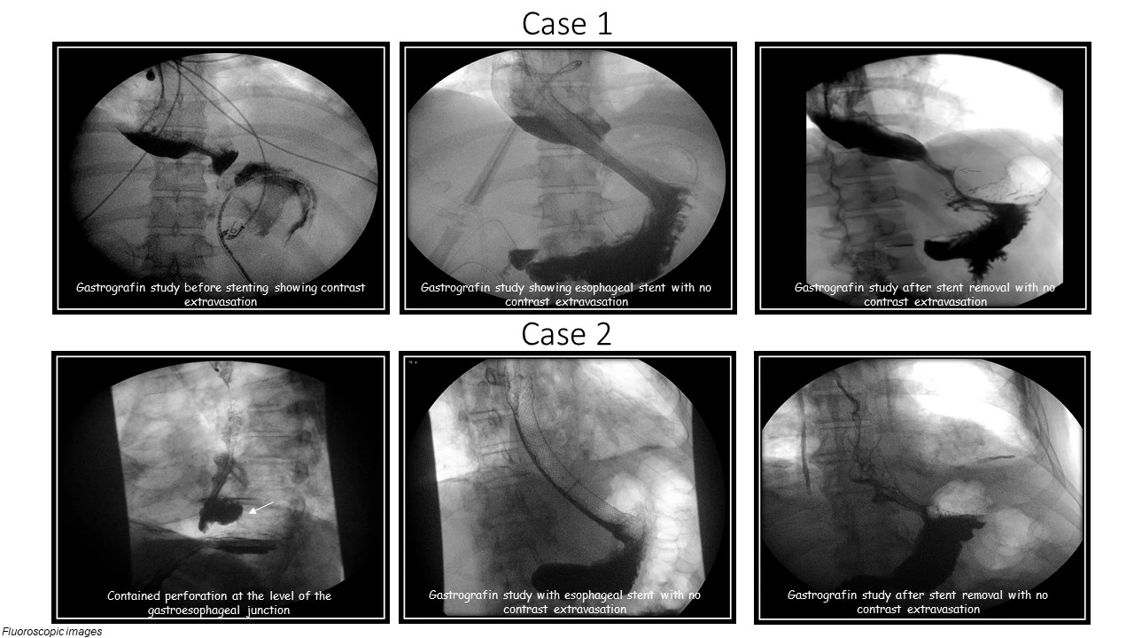 Case 1 and 2 fluoroscopic images