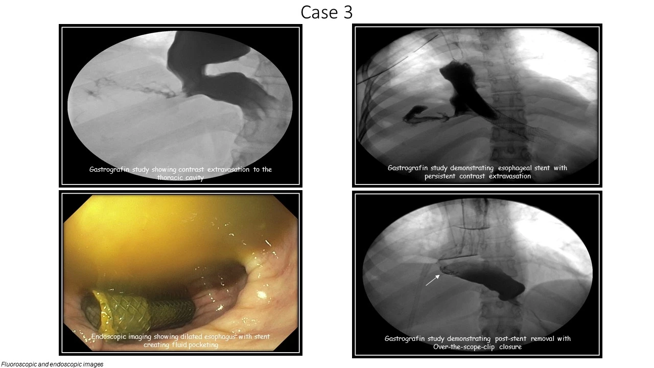 Case 3 endoscopic and fluoroscopic images