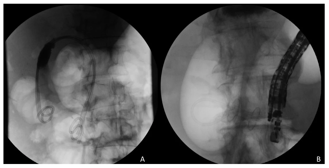 <b>Figure 1:  Comparison of ERCP-GBD (A) vs. EUS-GBD (B)</b>.  Fluoroscopic comparison of the two studied gallbladder drainage techniques.  Panel A demonstrates successful transpapillary drainage of the gallbladder, with two stents placed as definitive therapy.  Panel B demonstrates successful lumen-apposing metal stent placement into the gallbladder, as well as an indwelling pigtail drain to promote ongoing successful drainage.