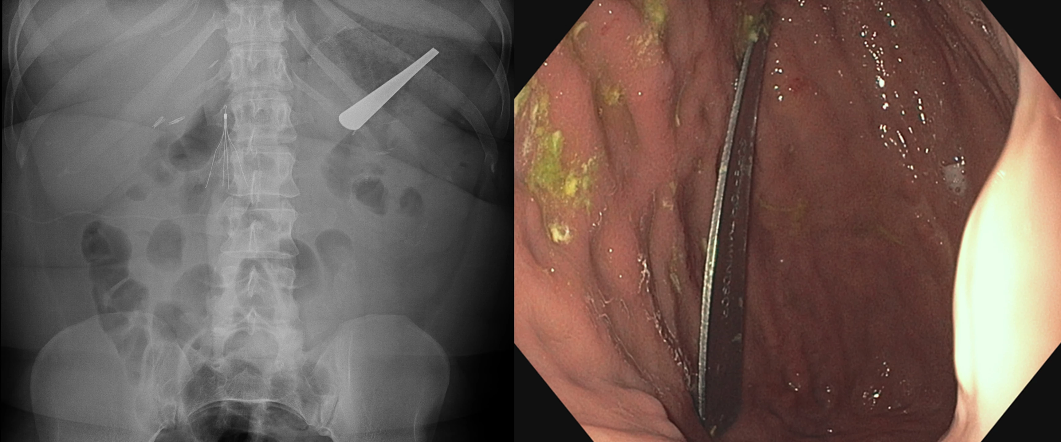 Abdominal radiograph and upper endoscopy demonstrating ingested metal blade in the stomach