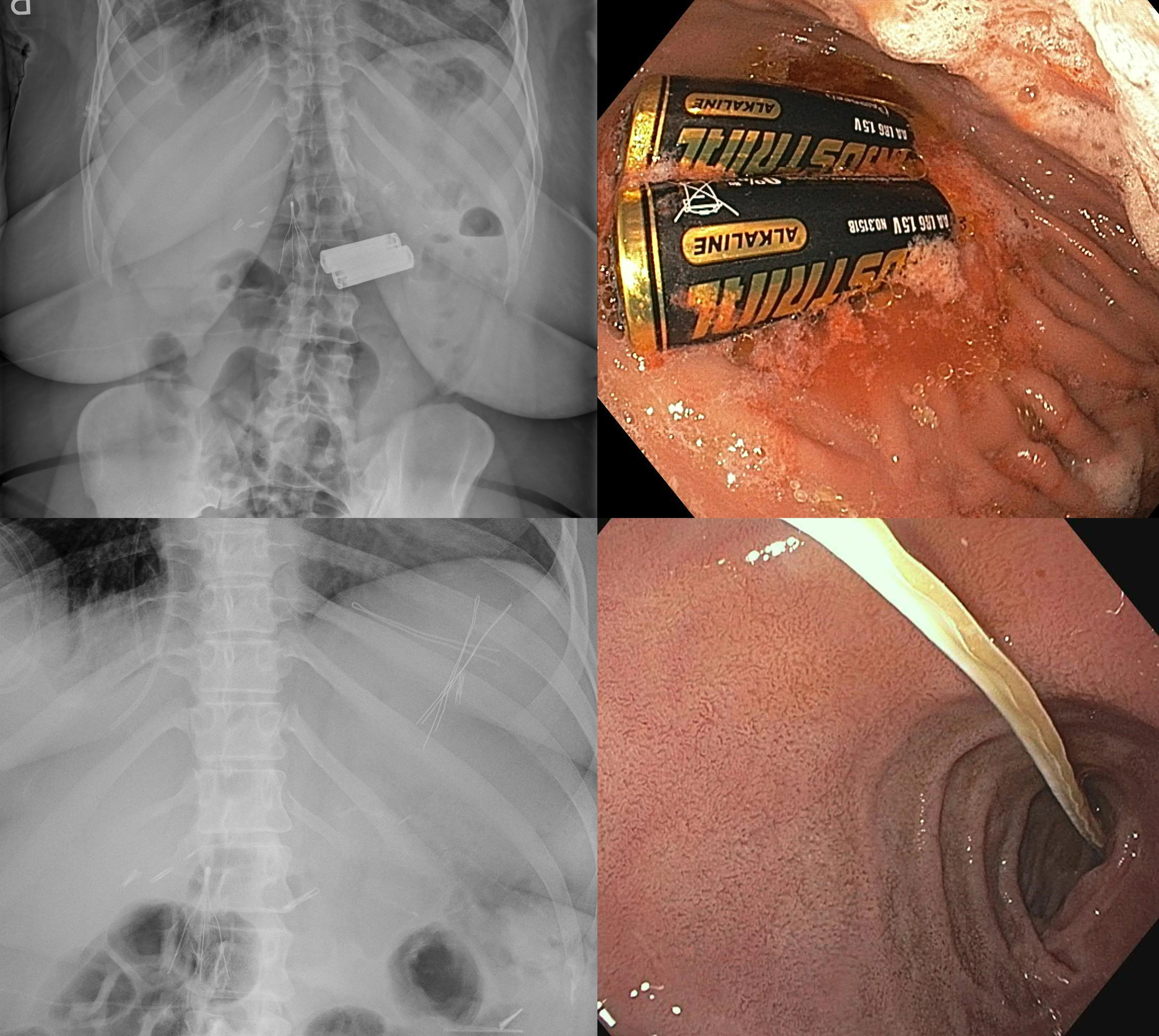 Abdominal radiograph and endoscopic images demonstrating ingested batteries and nasal bridge holder of face masks