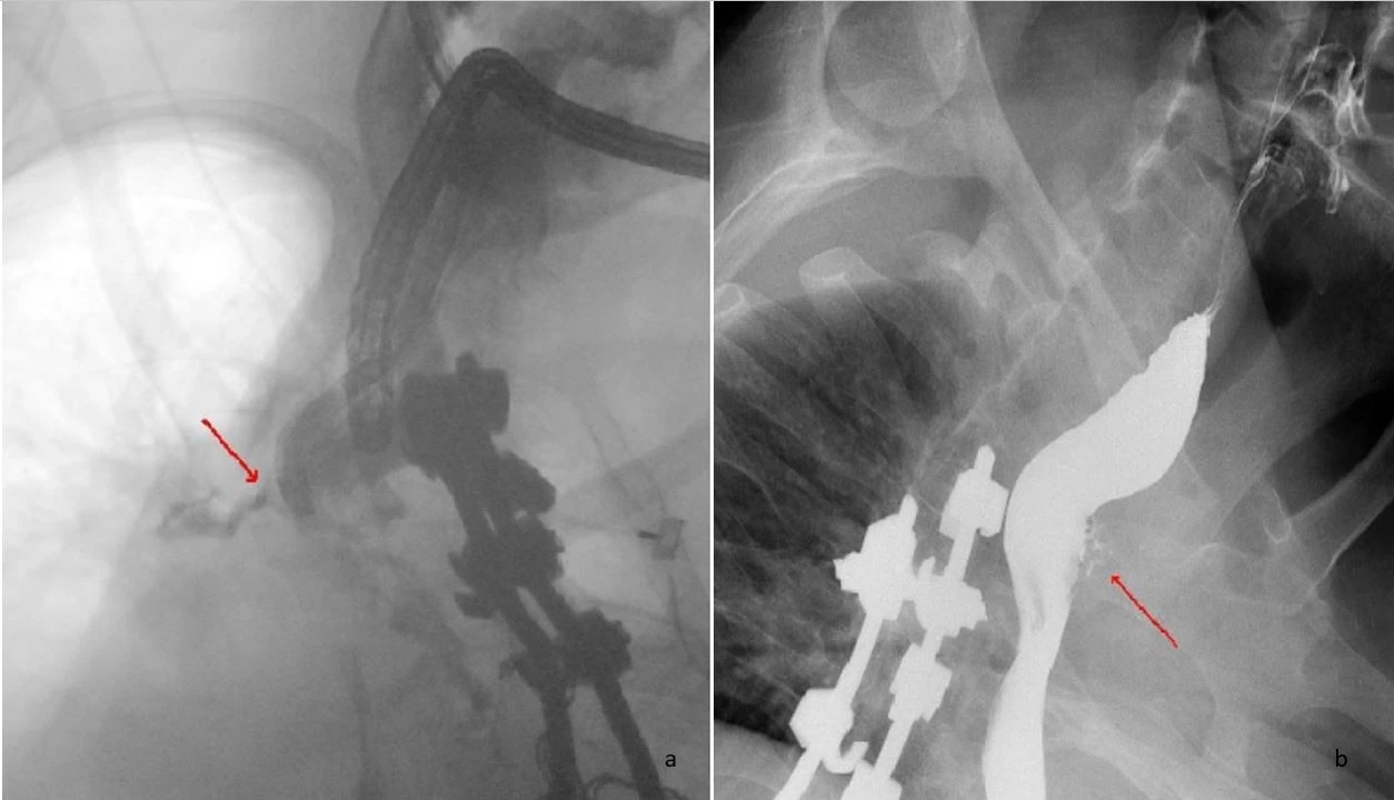 Figure 1<br /> a- Fistula leak<br /> b- Leak resloved after placing a SVS