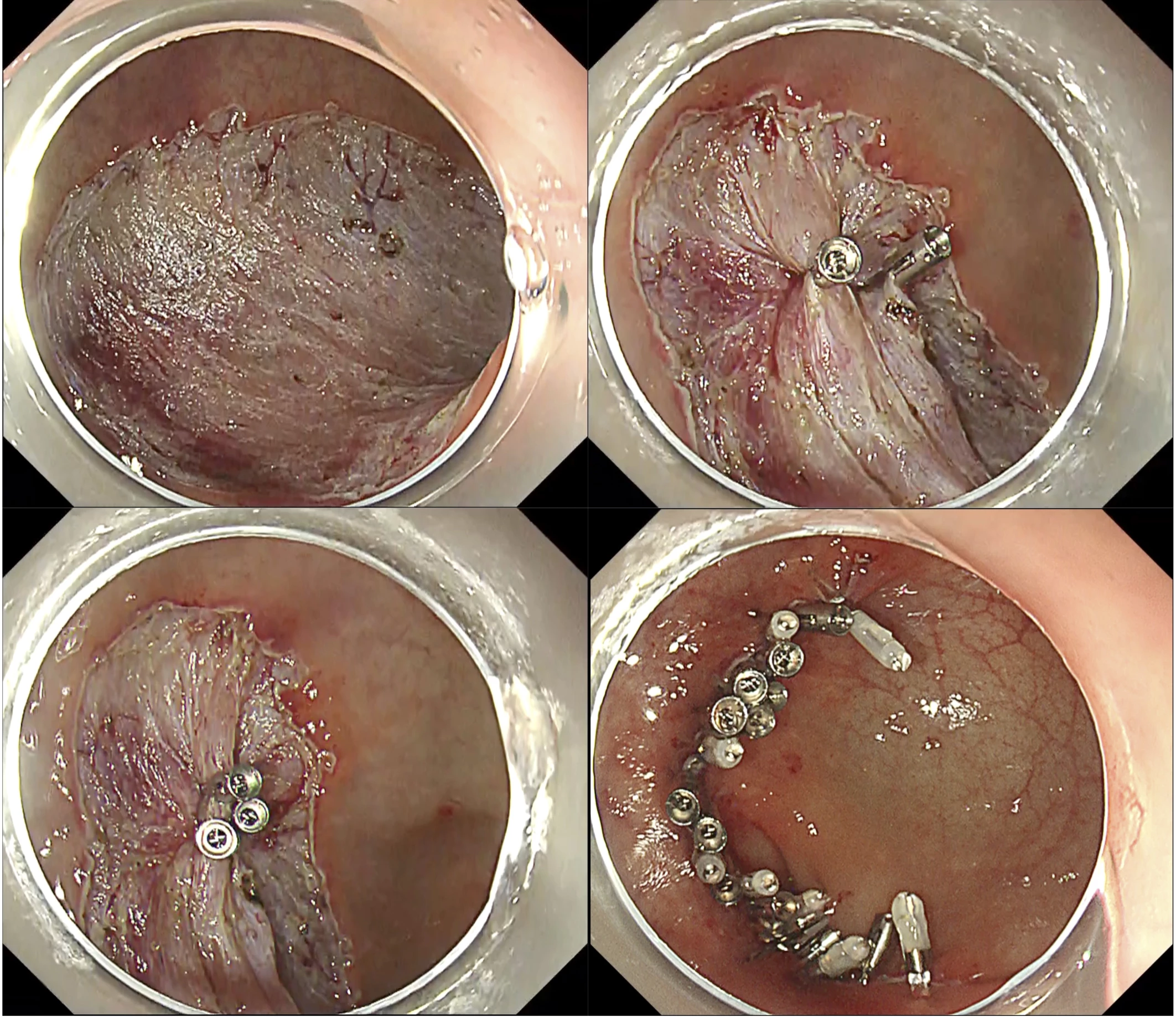<b>Modified double layered suturing, origami method (OGM)</b>