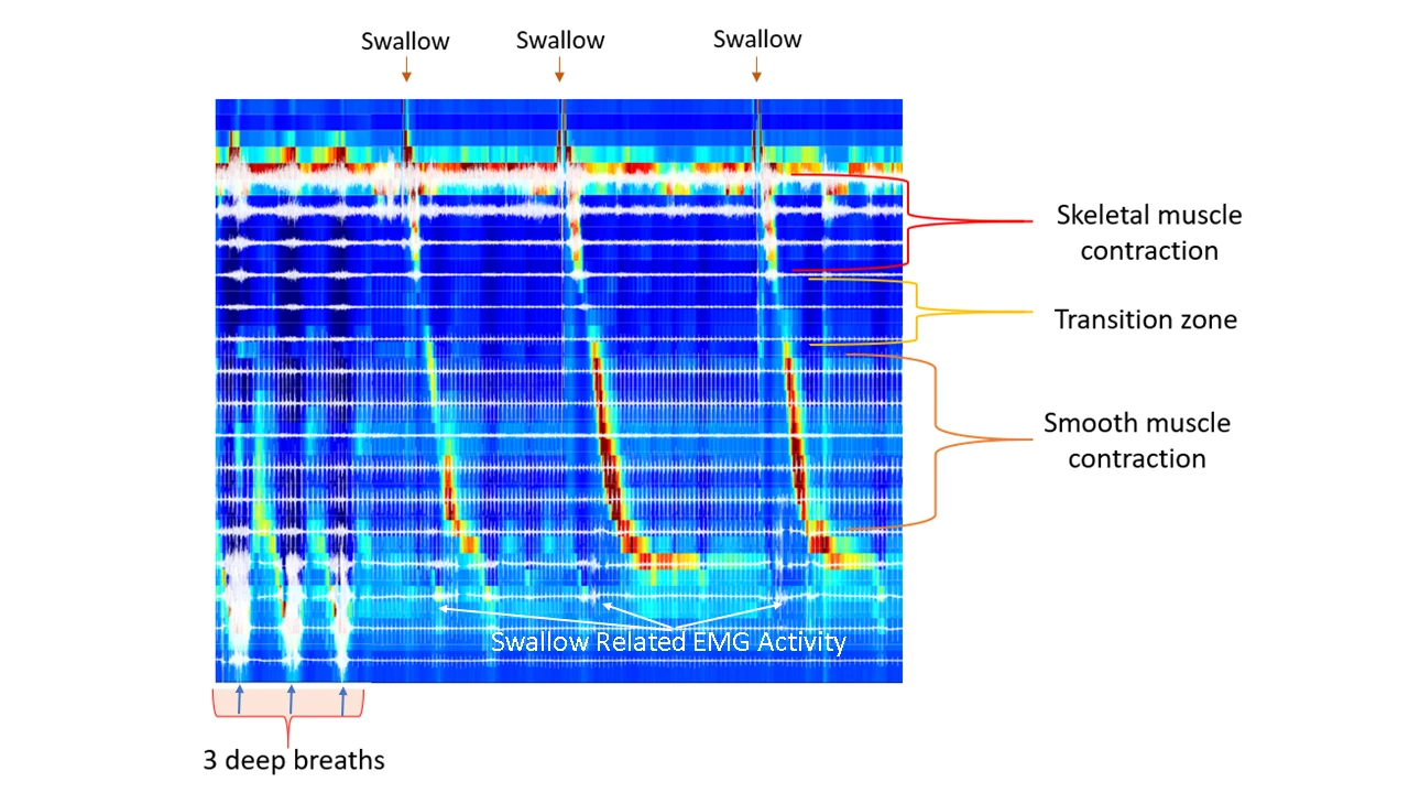 ManoEMG Recording From a Healthy Asymptomatic Subject. Fast electrical spike activity is seen in the regions of the skeletal muscle esophagus and upper esophageal sphincter. In the LES region, electrical spike bursts are seen with each inspiration and forced inspiration, see the text for detailed explanation.