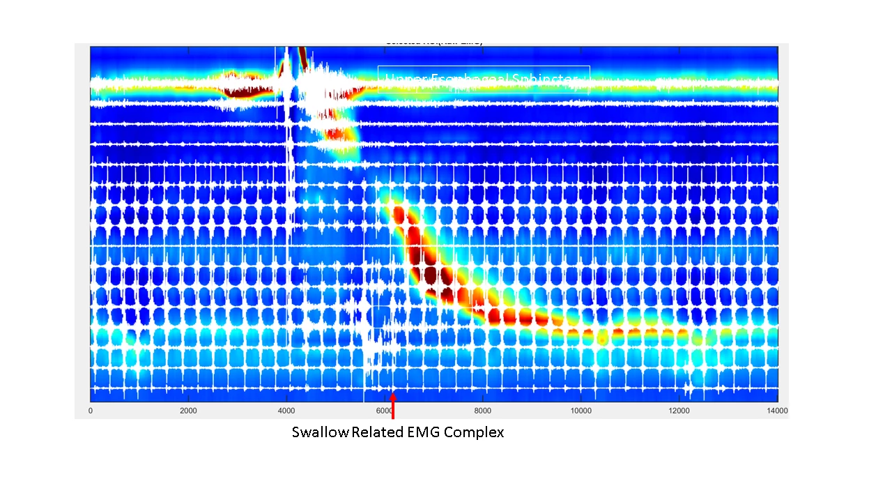 Note, the swallow-induced electrical spike burst in the LES region, at the onset of LES relaxation and prior to esophageal and LES contraction.