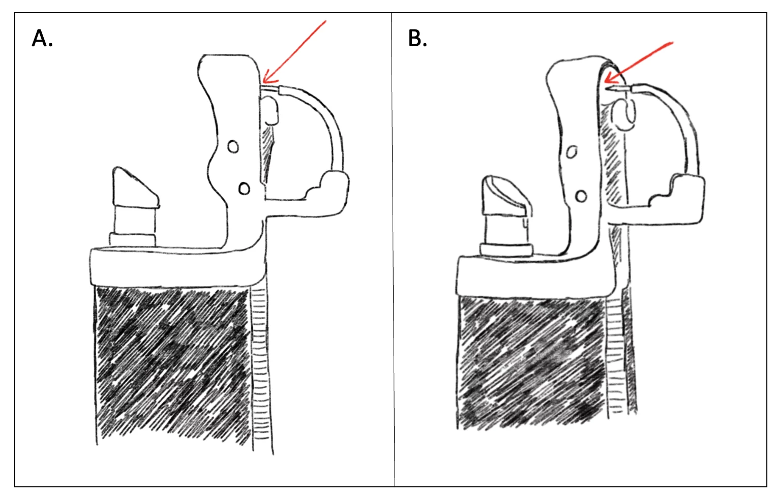 Figure 1. Diagrams demonstrating the small open space where stent interstices can become entrapped in the mounted OverStitch (Apollo) device with the needle driver in the “open” position (red arrow), most apparent with an oblique view shown in panel B