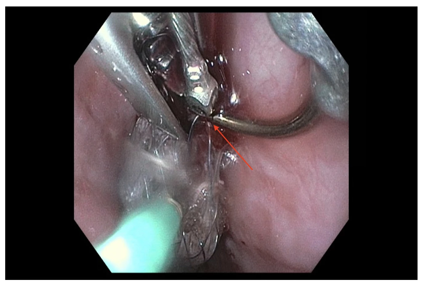 Figure 2. Endoscopic view of Case 1; stent trapped on needle driver in the “open” position (red arrow)