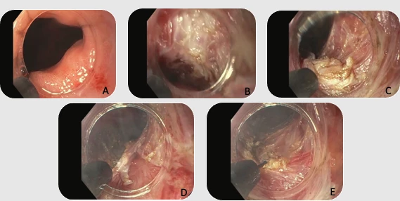 Figure 1. Diagram of lateral extension myotomy. A, GEJ after initial myotomy appears widely patient but with low DI < 2.8. B, Initial myotomy performed in anterior orientation demonstrating outer longitudinal muscle. C, Endoscope rotated clockwise so the longitudinal muscle initially located at 1 o’clock orientation now in 4 o’clock orientation. Thick circular muscle visualized at 6 o’clock position immediately lateral to initial myotomy segment. D, Circular muscle myotomy performed at 6 o’clock orientation exposing outer longitudinal muscle. E, Rescue lateral myotomy completed within the same myotomy length of initial myotomy with exposure of outer longitudinal muscle.