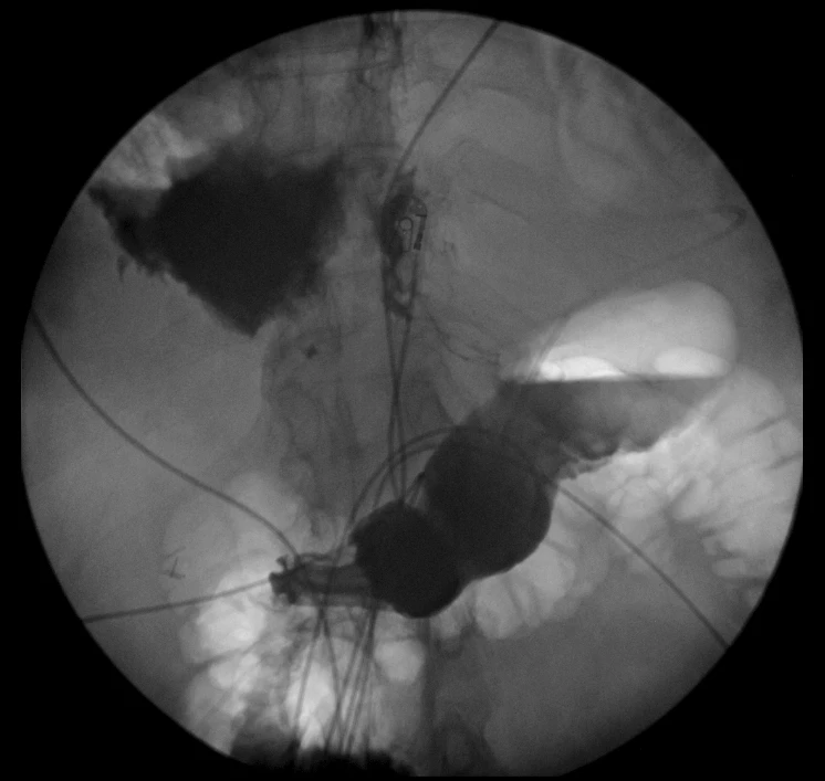 Figure 1: Active extravasation of contrast into pericardial space