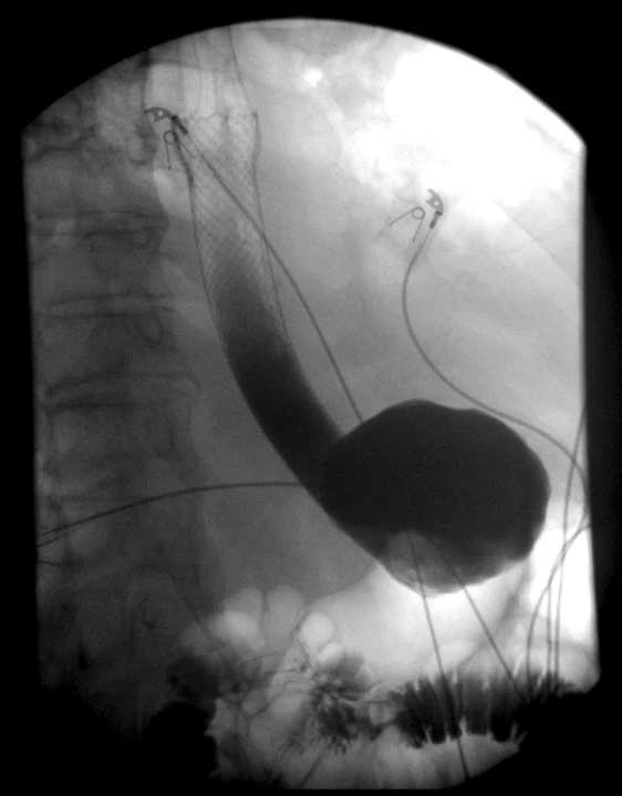 Figure 2: Post esophageal stent placement without extravasation of contrast