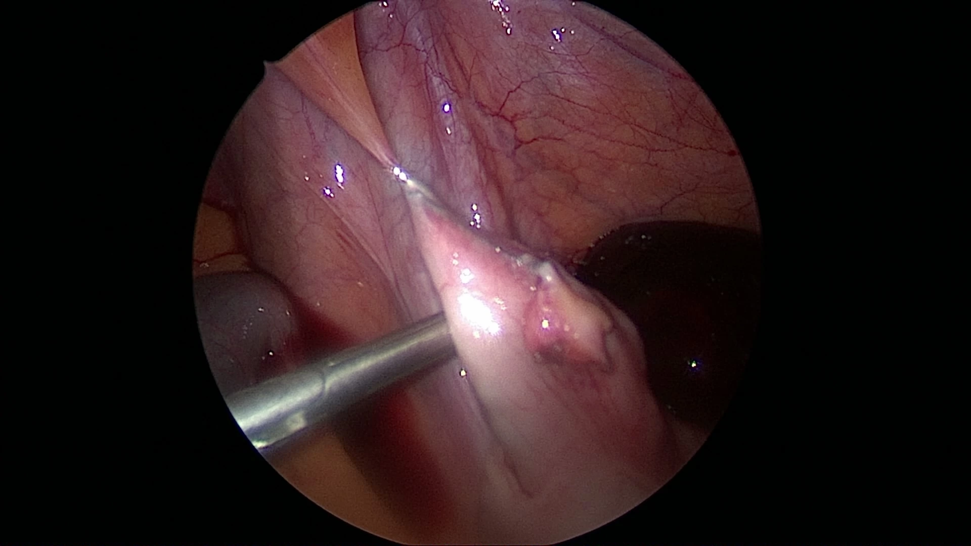 Full thickness X-tack into the mesentery