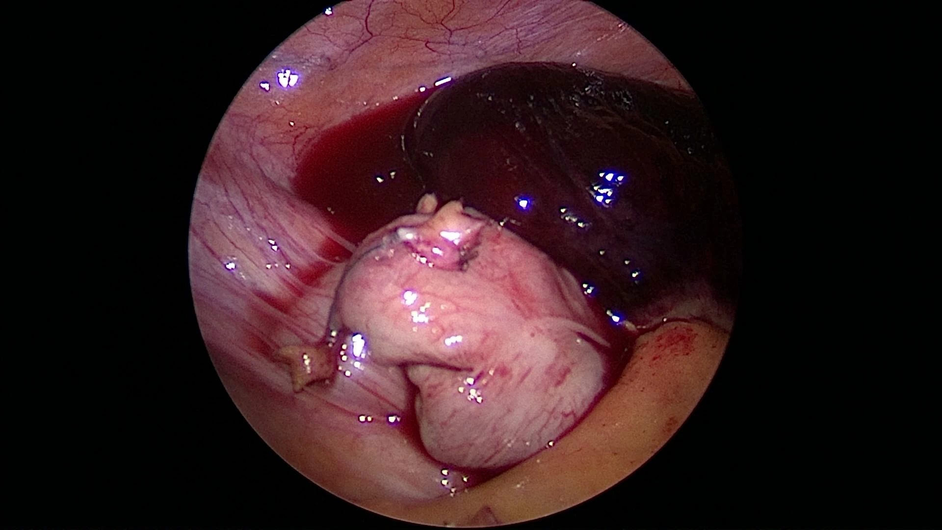 Closed loop small bowel obstruction related to full thickness X-tack