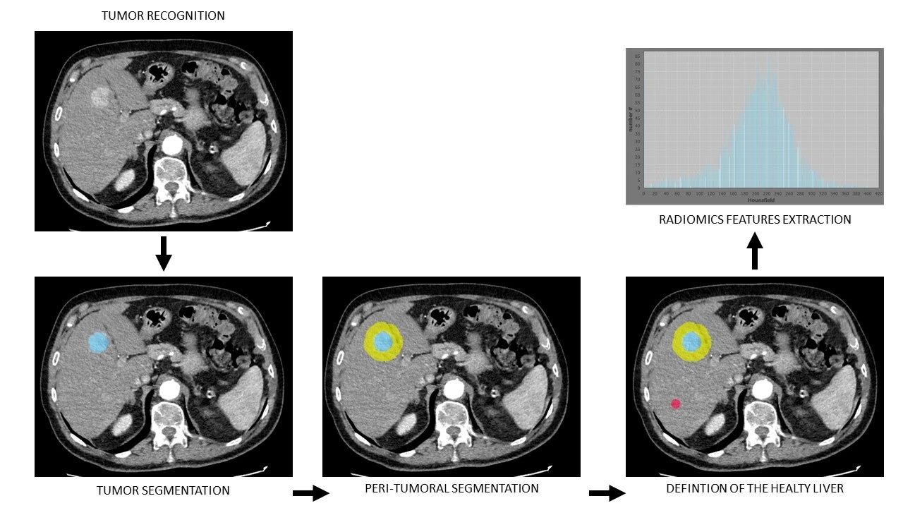 Steps followed to manually segment the liver, the tumor, the peritumoral area and the healthy liver area by the creation of a 2D-region of interest (ROI). Then, radiomics features extraction was made by LIFEex in the selected ROI.