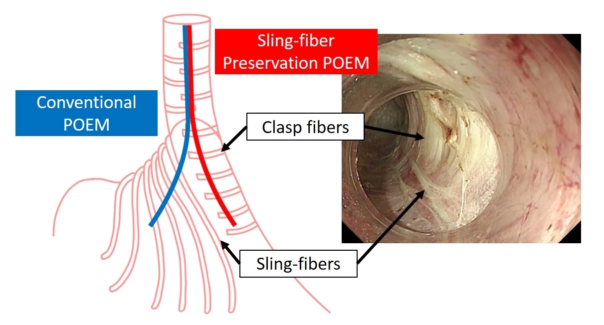 Diagram of sling fibers and clasp fibers. The red line represents the myotomy line in sling-fiber preservation POEM, while the blue line represents the myotomy line of conventional POEM (A). Endoscopic image of a submucosal tunnel showcasing both sling fibers and clasp fibers (B).