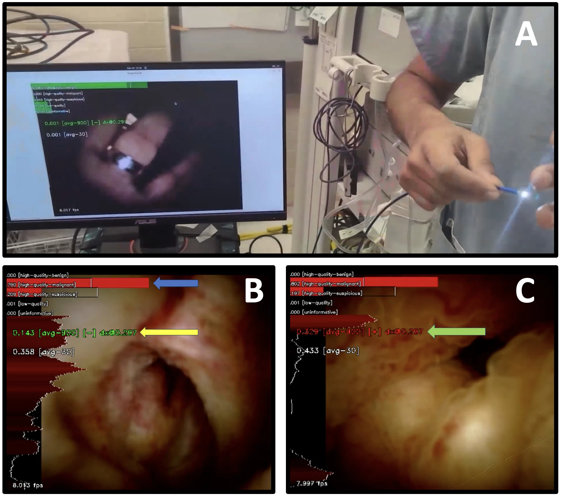 <b>Figure 1A-C. A - </b>Image of the real-time, point-of-care AI console. <b>B -</b> Demonstration of the real time AI in use for a patient with cholangiocarcinoma. The blue arrow points to a running bar graph that indicates the AI prediction on a per-frame basis, whereas the yellow arrow points to the overall score for the entire video at that point in the examination. <b>C - </b>Later in the examination, the score has crossed the threshold (green arrow) indicating a correct prediction from the AI that the patient had malignancy.