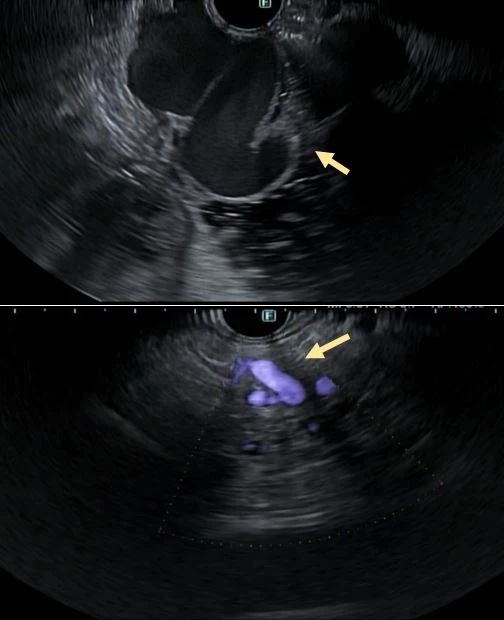 <b>Figure 2</b>. Duodenal Varix Pre- (Top) And Post- (Bottom) EUS-glue/coil Ablation