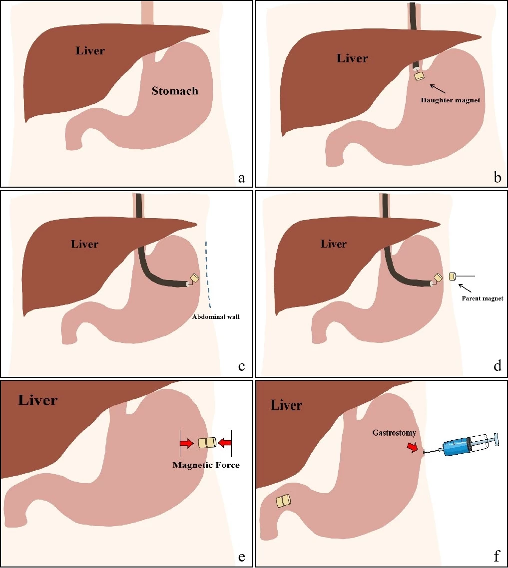 a. Anatomic relationship between liver and stomach. b. The daughter magnet was inserted into gastral cavity endoscopically. c. Deliver daughter magnet to the anterior gastric wall and close to the abdominal wall. d. The parent magnet was placed outside the abdominal wall and located in accordance with the position of daughter magnet. e. The two magnets were attracted under the magnetic force automatically. f. Magnetic compression resulting in tissue necrosis and fallen in few days, gastrostomy was established.