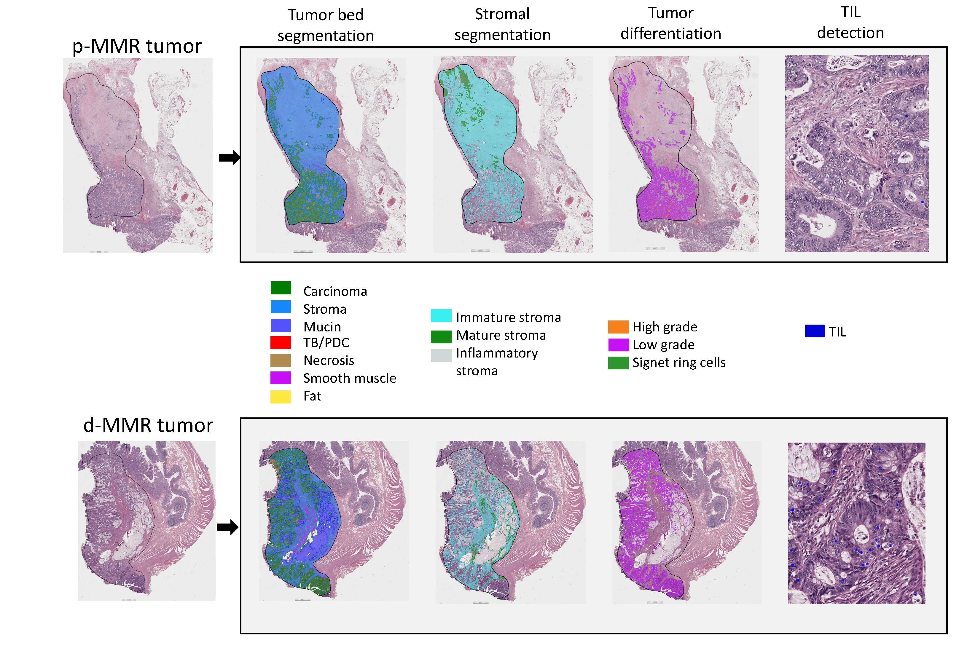 QuantCRC detects tumor morphological features in four layers.  Abbreviations: TB/PDC, tumor budding/poorly differentiated cluster; TIL, tumor infiltrating lymphocytes.