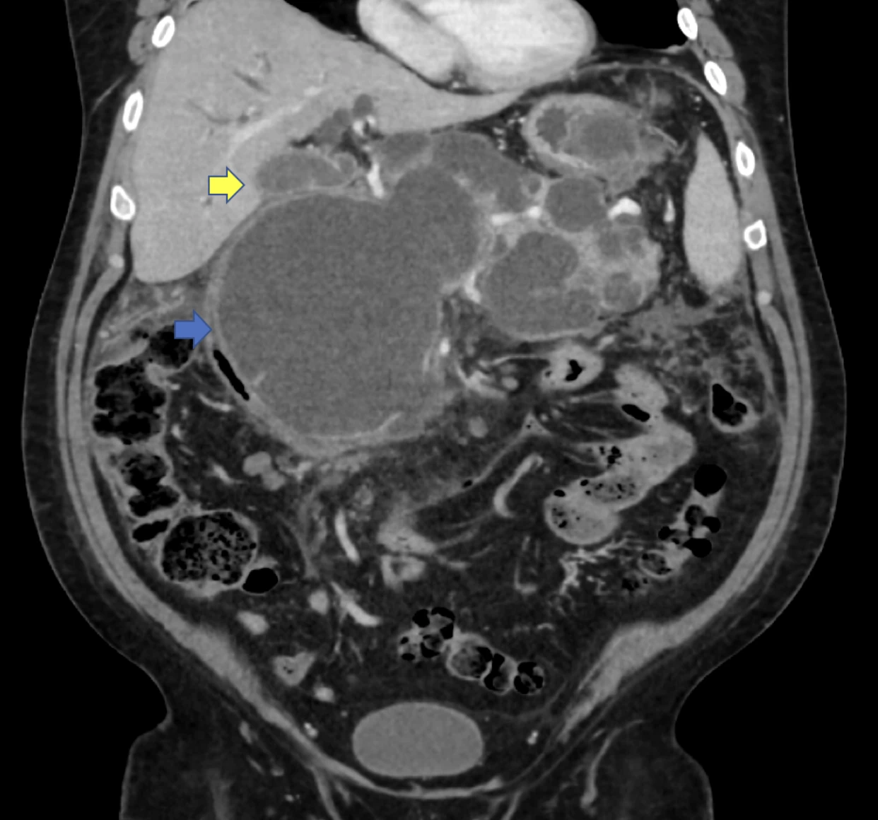 <b>Figure 1: Large pancreatic pseudocyst (blue arrow) compressing bile duct and leading to biliary dilation (yellow arrow).</b>